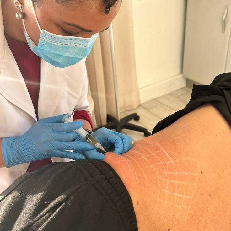 Non-surgical back fat dissolving treatment targeting bra bulge and upper back fat for a smoother silhouette