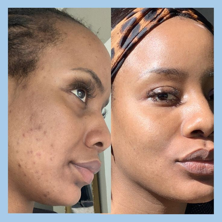 Image of cheek filler or chin filler treatment, showing before-and-after results.