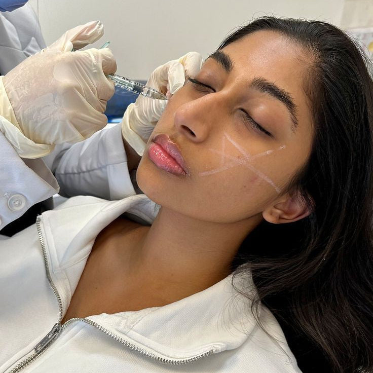 Dermal Filler Treatment