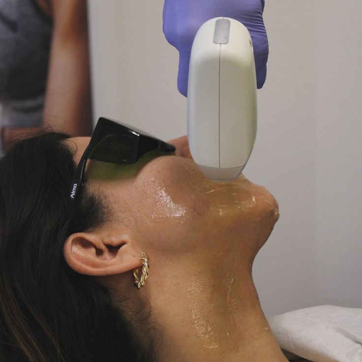 Full face laser hair removal treatment for permanent hair reduction on the upper lip, chin, cheeks, and jawline