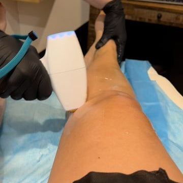 Legs laser hair removal treatment for permanent hair reduction on both upper and lower legs for smooth, soft skin