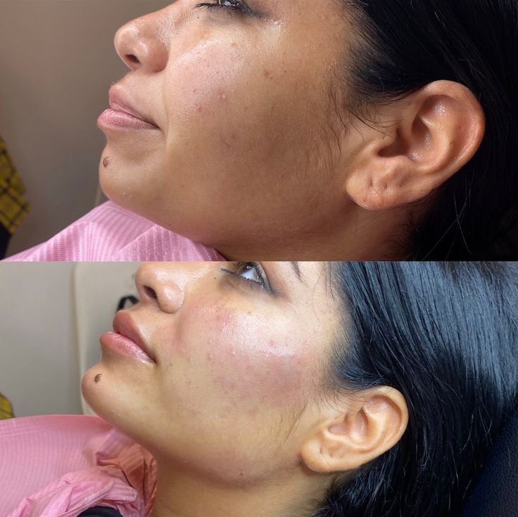 Youthful facial rejuvenation