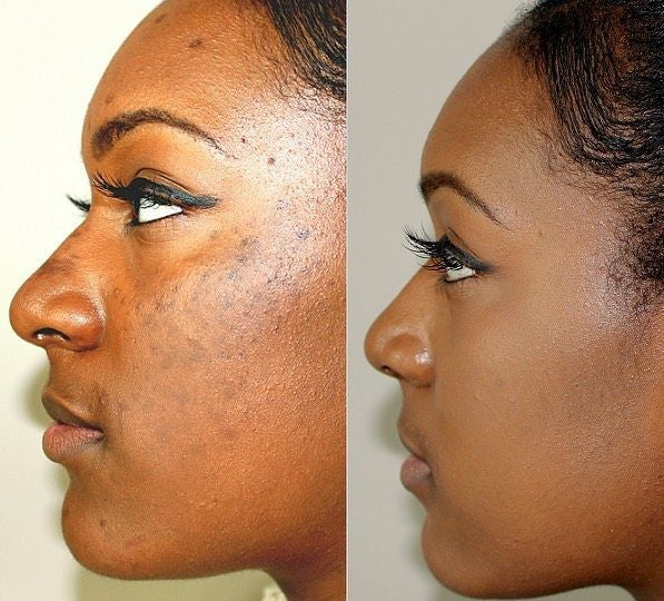 Advanced skin brightening and anti-ageing IV treatment