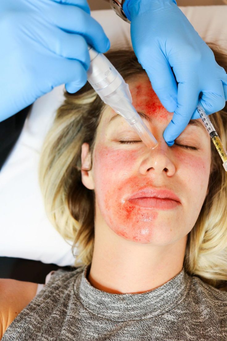 Vampire Facial treatment with microneedling and platelet-rich plasma (PRP) for skin rejuvenation and collagen production