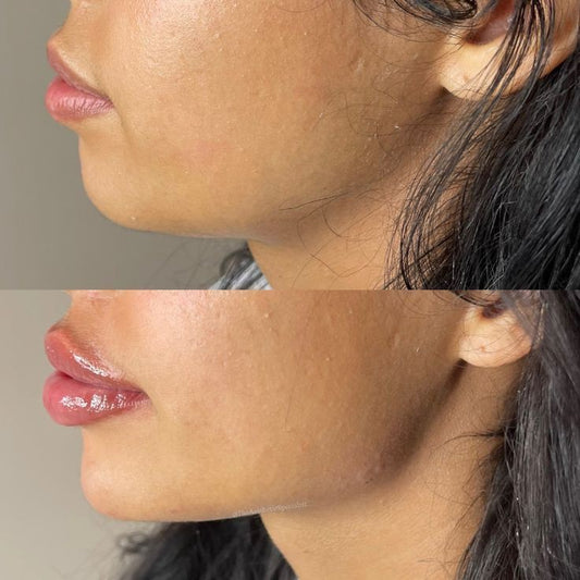 Jawline slimming and contouring treatment